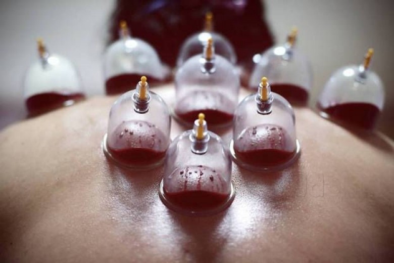 Hijama
